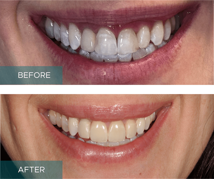 Side-by-side close-up of a person's smile. The "before" image shows discolored and uneven teeth, while the "after" image displays whiter, evenly aligned teeth.
