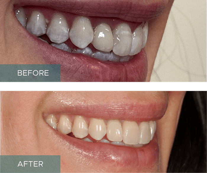 Side-by-side close-up of a person's smile. The "before" image shows discolored and uneven teeth, while the "after" image displays whiter, evenly aligned teeth.