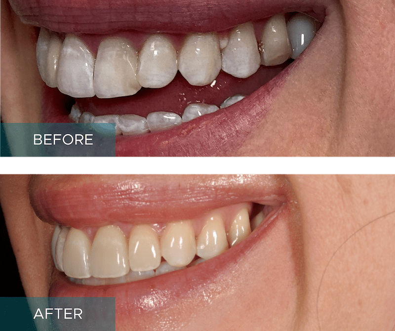 Side-by-side close-up of a person's smile. The "before" image shows discolored and uneven teeth, while the "after" image displays whiter, evenly aligned teeth.