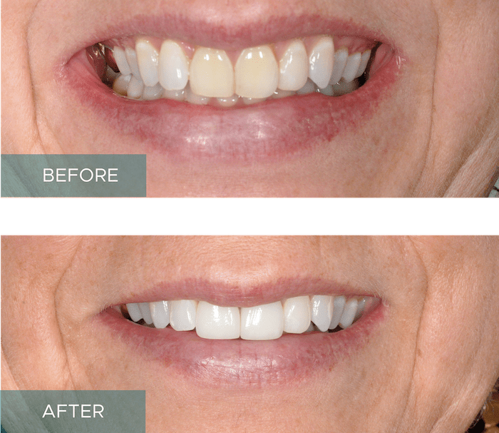 Side-by-side close-up of a person's smile. The "before" image shows discolored and uneven teeth, while the "after" image displays whiter, evenly aligned teeth.