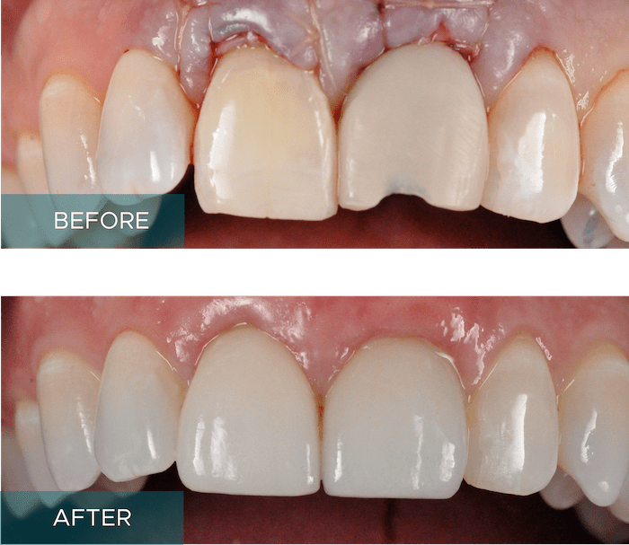 Full-Mouth Crowns Veneers Results