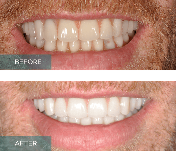 All-On-4 Implants Results