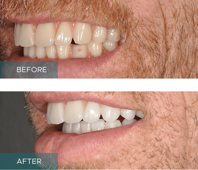 Side-by-side close-up of a person's smile. The "before" image shows discolored and uneven teeth, while the "after" image displays whiter, evenly aligned teeth.