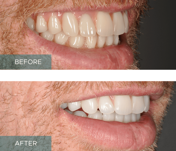 Side-by-side close-up of a person's smile. The "before" image shows discolored and uneven teeth, while the "after" image displays whiter, evenly aligned teeth.