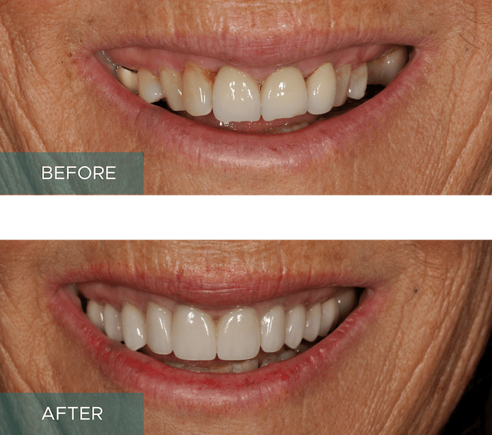 Full Rehab Crowns Results