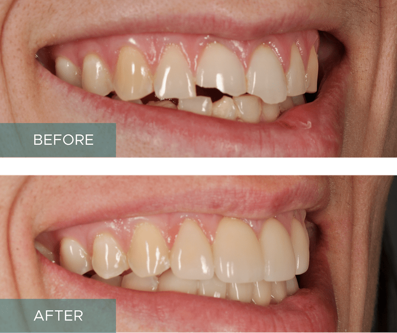 Side-by-side close-up of a person's smile. The "before" image shows discolored and uneven teeth, while the "after" image displays whiter, evenly aligned teeth.