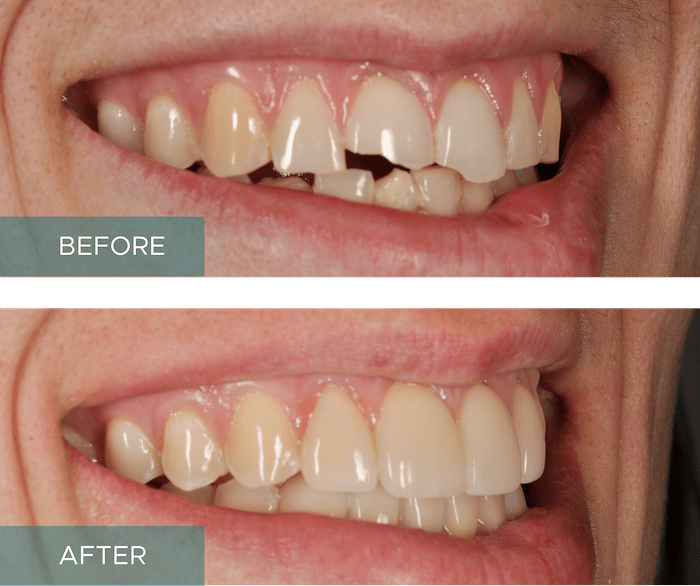 Side-by-side close-up of a person's smile. The "before" image shows discolored and uneven teeth, while the "after" image displays whiter, evenly aligned teeth.