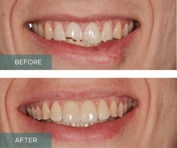 Side-by-side close-up of a person's smile. The "before" image shows discolored and uneven teeth, while the "after" image displays whiter, evenly aligned teeth.