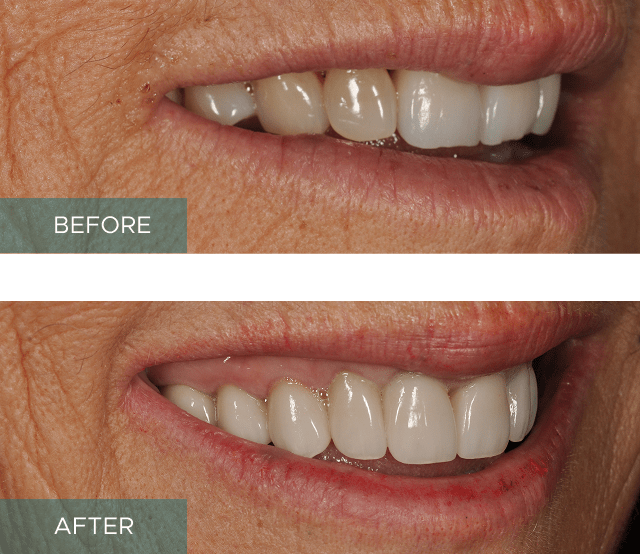 Crowns Bridges Results B
