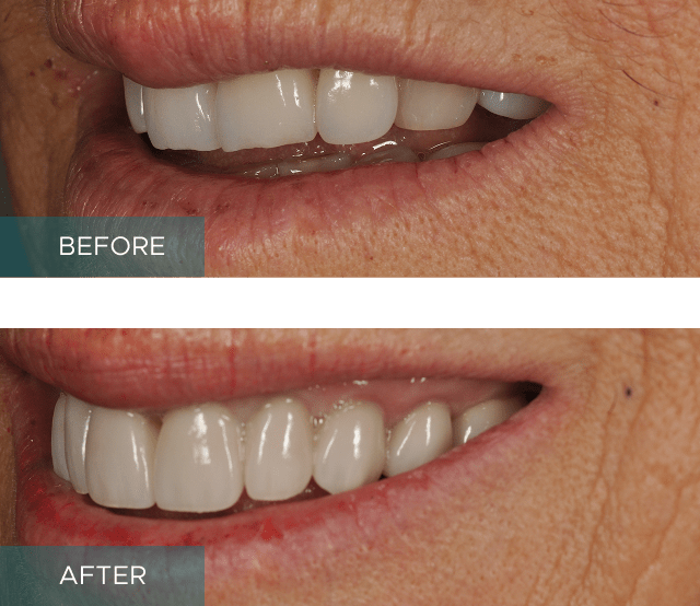 Side-by-side close-up of a person's smile. The "before" image shows discolored and uneven teeth, while the "after" image displays whiter, evenly aligned teeth.