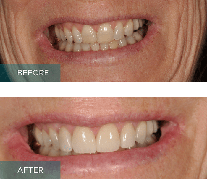 Veneers Crowns Makeover Results