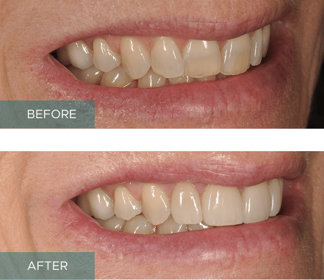 Side-by-side close-up of a person's smile. The "before" image shows discolored and uneven teeth, while the "after" image displays whiter, evenly aligned teeth.