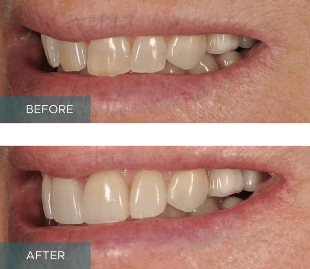 Side-by-side close-up of a person's smile. The "before" image shows discolored and uneven teeth, while the "after" image displays whiter, evenly aligned teeth.