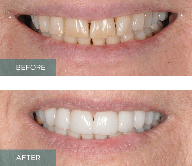 Side-by-side close-up of a person's smile. The "before" image shows discolored and uneven teeth, while the "after" image displays whiter, evenly aligned teeth.