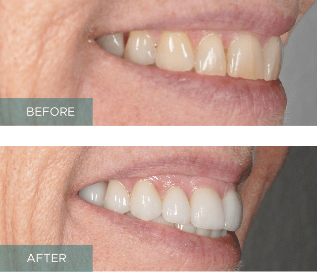 Side-by-side close-up of a person's smile. The "before" image shows discolored and uneven teeth, while the "after" image displays whiter, evenly aligned teeth.