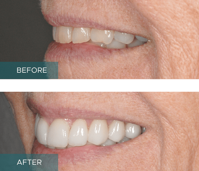 Side-by-side close-up of a person's smile. The "before" image shows discolored and uneven teeth, while the "after" image displays whiter, evenly aligned teeth.