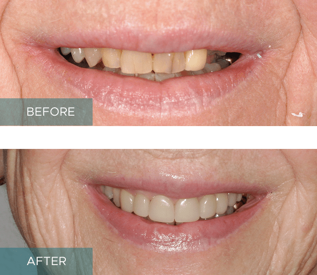Side-by-side close-up of a person's smile. The "before" image shows discolored and uneven teeth, while the "after" image displays whiter, evenly aligned teeth.