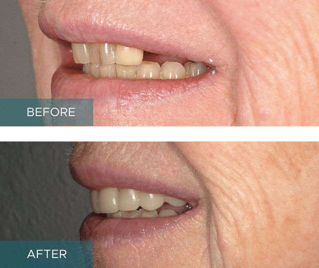 Side-by-side close-up of a person's smile. The "before" image shows discolored and uneven teeth, while the "after" image displays whiter, evenly aligned teeth.
