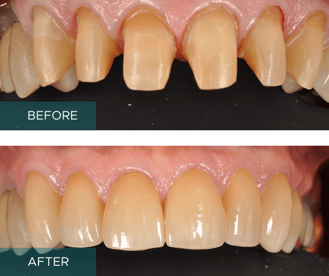 Porcelain Veneers Results