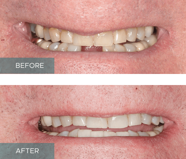 Side-by-side close-up of a person's smile. The "before" image shows discolored and uneven teeth, while the "after" image displays whiter, evenly aligned teeth.
