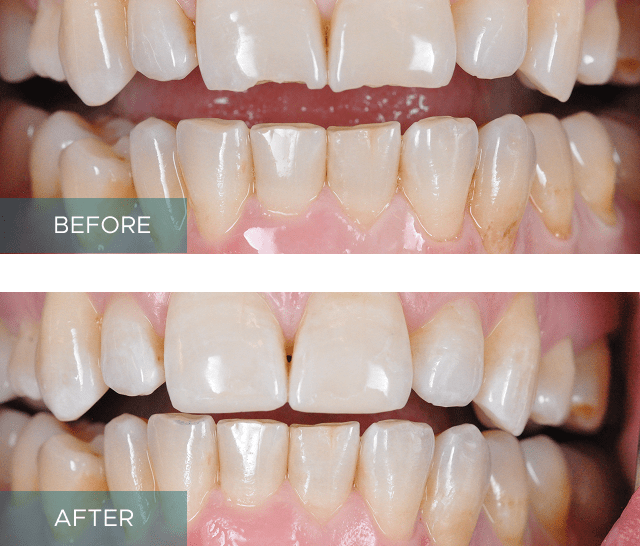 Composite Bonding Results