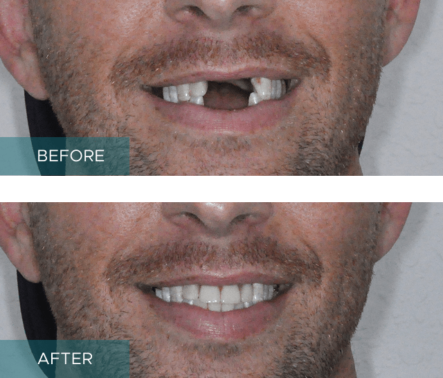Gum Veneers Treatment Results