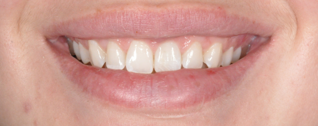 Boco Dental Veneers Infographic Before And After Results.