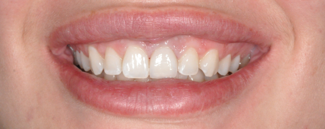 After Porcelain Veneers Transformation Photo