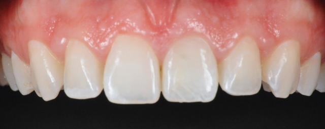 Porcelain Veneers Before And After Smile Makeover Photo