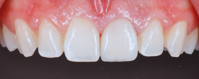 Smile Transformation After Veneers Photo