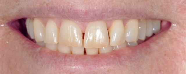 Boco Dental Porcelain Veneers Result Single Tooth Fix Photo