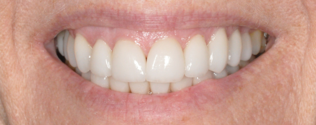 Before Porcelain Veneers Patient Smile Photo