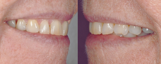 Before After Porcelain Veneers Photo