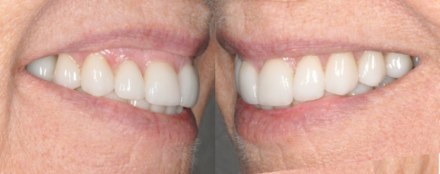 Multiple Porcelain Veneers Before Photo