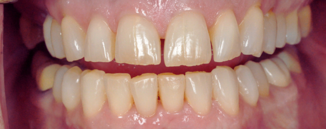 Porcelain Veneers Patient Before Treatment Photo
