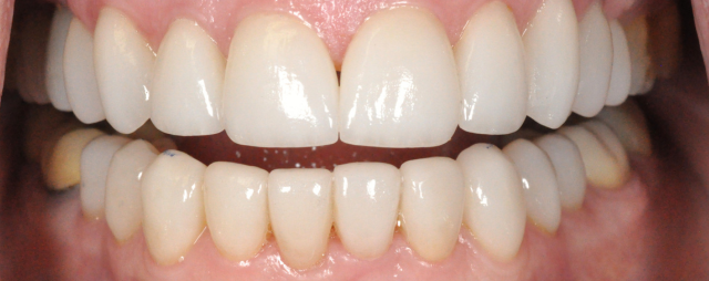 After E.Max Veneers And Crowns Full Smile Photo