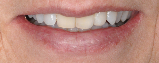 Dental Implant Restoration Results