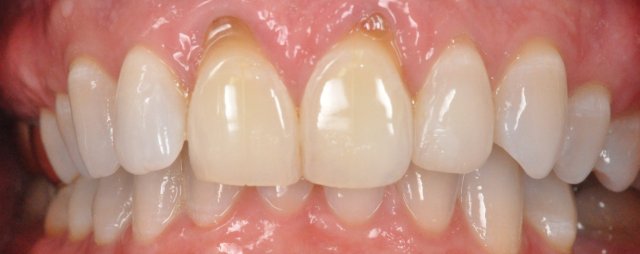 Dental Implant Restoration Process At Boco Dental Clinics