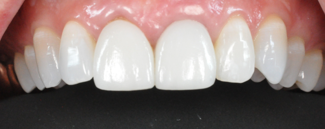 Before And After Dental Implant Results