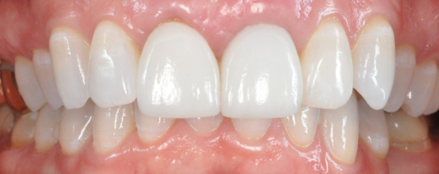Patient Smiling Post Dental Implant Results