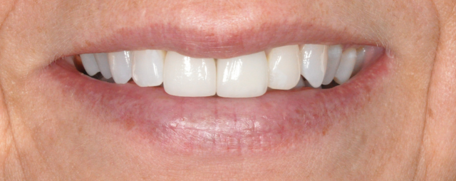 Boco Dental Porcelain Veneers Smile Transformation Shown